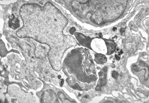 F, 36y. | generalized eruptive histiocytoma - histiocyte F, 36y. | generalized eruptive histiocytoma - histiocyte